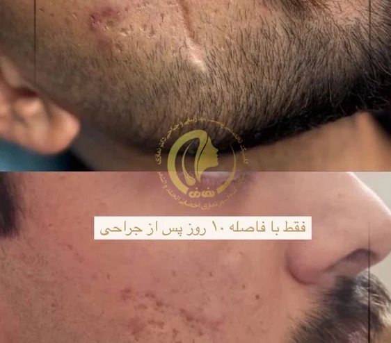 جراحی اسکار صورت