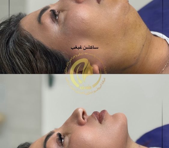 ساکشن غبغب