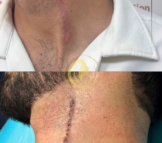 جراحی اسکار گردن