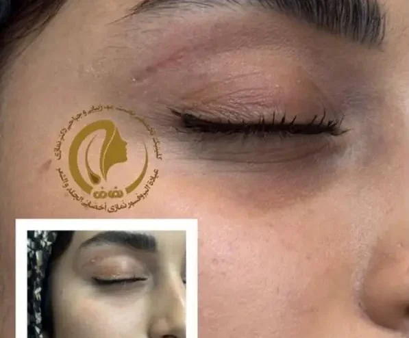 برداشتن ضایعه پوستی