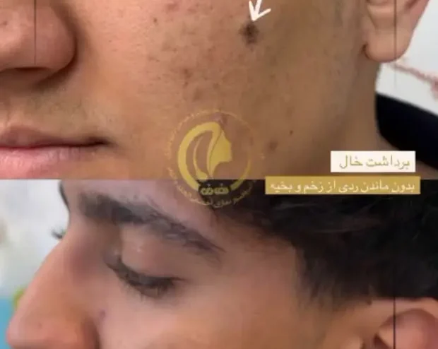 جراحی خال