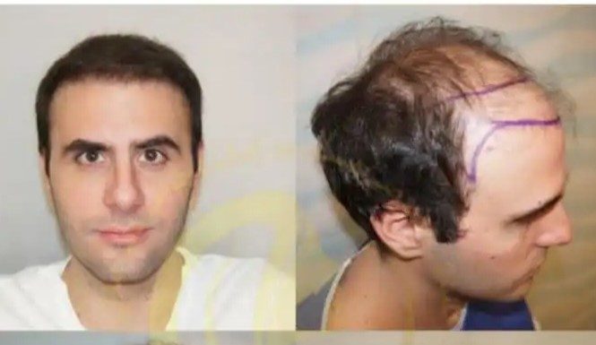 کاشت مو